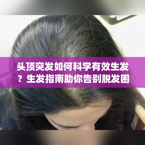 頭頂突發(fā)如何科學(xué)有效生發(fā)？生發(fā)指南助你告別脫發(fā)困擾！